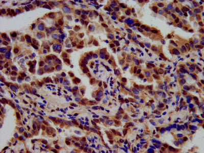 IHC image of TSPAN9 Antibody diluted at 1:700 and staining in paraffin-embedded human lung cancer performed on a Leica BondTM system. After dewaxing and hydration, antigen retrieval was mediated by high pressure in a citrate buffer (pH 6.0). Section was blocked with 10% normal goat serum 30min at RT. Then primary antibody (1% BSA) was incubated at 4°C overnight. The primary is detected by a biotinylated secondary antibody and visualized using an HRP conjugated SP system.Rabbit anti-Human TSPAN9 Polyclonal Antibody