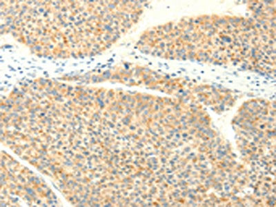 The image on the left is immunohistochemistry of paraffin-embedded Human liver cancer tissue using TRAF3IP2 Antibody(TRAF3IP2 Antibody) at dilution 1/25, on the right is treated with fusion protein. (Original magnification: ×200)Rabbit anti-Human TRAF3IP2 Polyclonal Antibody
