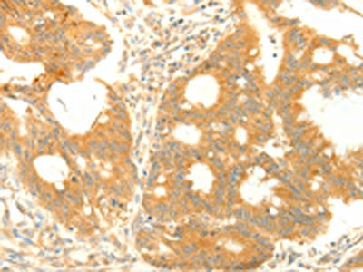 The image on the left is immunohistochemistry of paraffin-embedded Human colon cancer tissue using the antibody Antibody) at dilution 1/25, on the right is treated with fusion protein. (Original magnification: ×200)Rabbit anti-Human TRAF3IP2 Polyclonal Antibody