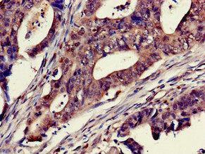 Immunohistochemistry of paraffin-embedded human colon cancer using TTK Antibody at dilution of 1:100Rabbit anti-Human TTK Polyclonal Antibody
