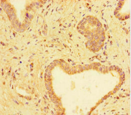 Immunohistochemistry of paraffin-embedded human prostate cancer using the antibody at dilution of 1:100Rabbit anti-Human TUBA1C Polyclonal Antibody