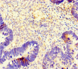 Immunohistochemistry of paraffin-embedded human ovarian cancer using TUBB4A Antibody at dilution of 1:100Rabbit anti-Human TUBB4A Polyclonal Antibody