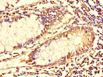Immunohistochemistry of paraffin-embedded human colon cancer using TUBG1 Antibody at dilution of 1:100Rabbit anti-Human TUBG1 Polyclonal Antibody