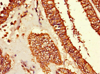 Immunohistochemistry of paraffin-embedded human endometrial cancer using TUBG1 Antibody at dilution of 1:100Rabbit anti-Human TUBG1 Polyclonal Antibody