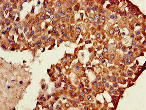 Immunohistochemistry of paraffin-embedded human breast cancer using TXK Antibody at dilution of 1:100Rabbit anti-Human TXK Polyclonal Antibody