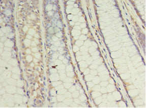 Immunohistochemistry of paraffin-embedded human colon cancer using UBE2C Antibody at dilution of 1:100Rabbit anti-Human UBE2C Polyclonal Antibody