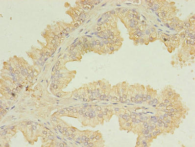Immunohistochemistry of paraffin-embedded human prostate cancer using UBE2D1 Antibody at dilution of 1:100Rabbit anti-Human UBE2D1 Polyclonal Antibody