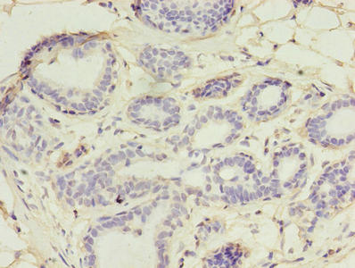 Immunohistochemistry of paraffin-embedded human breast cancer using UBE2D1 Antibody at dilution of 1:100Rabbit anti-Human UBE2D1 Polyclonal Antibody