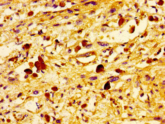 Immunohistochemistry of paraffin-embedded human melanoma using the antibody at dilution of 1:100Rabbit anti-Human UBE2D2 Polyclonal Antibody