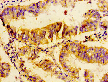 Immunohistochemistry of paraffin-embedded human endometrial cancer using UBE2D2 Antibody at dilution of 1:100Rabbit anti-Human UBE2D2 Polyclonal Antibody