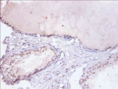 Immunohistochemistry of paraffin-embedded human prostate tissue using HNRNPD Antibody at dilution of 1:100Rabbit anti-Human HNRNPD Polyclonal Antibody