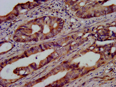 IHC image of the antibody diluted at 1:500 and staining in paraffin-embedded human colon cancer performed on a Leica BondTM system. After dewaxing and hydration, antigen retrieval was mediated by high pressure in a citrate buffer (pH 6.0). Section was blocked with 10% normal goat serum 30min at RT. Then primary antibody (1% BSA) was incubated at 4°C overnight. The primary is detected by a biotinylated secondary antibody and visualized using an HRP conjugated SP system.Rabbit anti-Human UBE2G1 Polyclonal Antibody