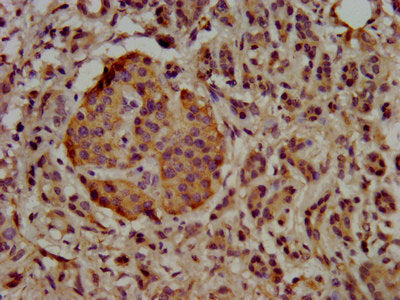 IHC image of UBE2G1 Antibody diluted at 1:500 and staining in paraffin-embedded human pancreatic cancer performed on a Leica BondTM system. After dewaxing and hydration, antigen retrieval was mediated by high pressure in a citrate buffer (pH 6.0). Section was blocked with 10% normal goat serum 30min at RT. Then primary antibody (1% BSA) was incubated at 4°C overnight. The primary is detected by a biotinylated secondary antibody and visualized using an HRP conjugated SP system.Rabbit anti-Human UBE2G1 Polyclonal Antibody