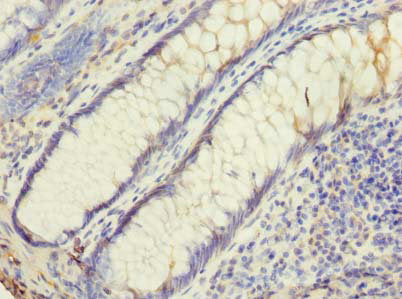 Immunohistochemistry of paraffin-embedded human colon cancer using UBE2G2 Antibody at dilution of 1:100Rabbit anti-Human UBE2G2 Polyclonal Antibody