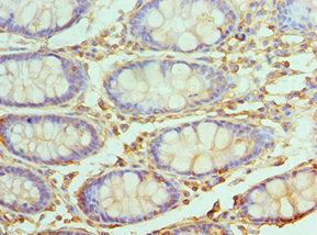Immunohistochemistry of paraffin-embedded human colon tissue using UBE2V2 Antibody at dilution of 1:100Rabbit anti-Human UBE2V2 Polyclonal Antibody