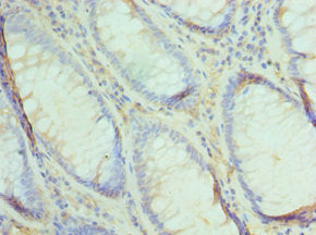 Immunohistochemistry of paraffin-embedded human colon cancer using UBE2V2 Antibody at dilution of 1:100Rabbit anti-Human UBE2V2 Polyclonal Antibody