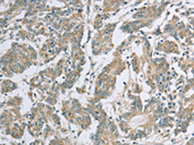 The image on the left is immunohistochemistry of paraffin-embedded Human colon cancer tissue using EDA2R Antibody(EDA2R Antibody) at dilution 1/50, on the right is treated with fusion protein. (Original magnification: ×200)Rabbit anti-Human EDA2R Polyclonal Antibody