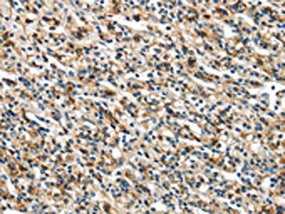 The image on the left is immunohistochemistry of paraffin-embedded Human prostate cancer tissue using GLP2R Antibody(GLP2R Antibody) at dilution 1/30, on the right is treated with fusion protein. (Original magnification: ×200)Rabbit anti-Human GLP2R Polyclonal Antibody