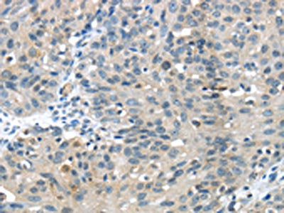 The image on the left is immunohistochemistry of paraffin-embedded Human breast cancer tissue using the antibody Antibody) at dilution 1/30, on the right is treated with fusion protein. (Original magnification: ×200)Rabbit anti-Human GLP2R Polyclonal Antibody