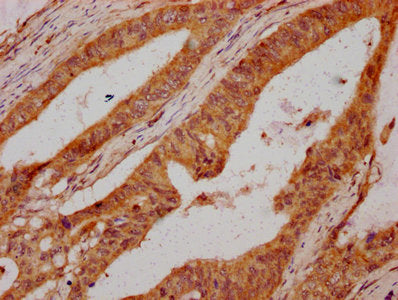 IHC image of UMODL1 Antibody diluted at 1:300 and staining in paraffin-embedded human colon cancer performed on a Leica BondTM system. After dewaxing and hydration, antigen retrieval was mediated by high pressure in a citrate buffer (pH 6.0). Section was blocked with 10% normal goat serum 30min at RT. Then primary antibody (1% BSA) was incubated at 4°C overnight. The primary is detected by a biotinylated secondary antibody and visualized using an HRP conjugated SP system.Rabbit anti-Human UMODL1 Polyclonal Antibody