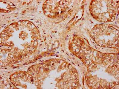 IHC image of UMODL1 Antibody diluted at 1:300 and staining in paraffin-embedded human prostate cancer performed on a Leica BondTM system. After dewaxing and hydration, antigen retrieval was mediated by high pressure in a citrate buffer (pH 6.0). Section was blocked with 10% normal goat serum 30min at RT. Then primary antibody (1% BSA) was incubated at 4°C overnight. The primary is detected by a biotinylated secondary antibody and visualized using an HRP conjugated SP system.Rabbit anti-Human UMODL1 Polyclonal Antibody
