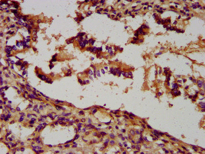 IHC image of the antibody diluted at 1:300 and staining in paraffin-embedded human lung tissue performed on a Leica BondTM system. After dewaxing and hydration, antigen retrieval was mediated by high pressure in a citrate buffer (pH 6.0). Section was blocked with 10% normal goat serum 30min at RT. Then primary antibody (1% BSA) was incubated at 4°C overnight. The primary is detected by a biotinylated secondary antibody and visualized using an HRP conjugated SP system.Rabbit anti-Human UNC5B Polyclonal Antibody