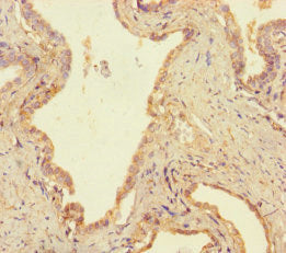 Immunohistochemistry of paraffin-embedded human prostate cancer using USP14 Antibody at dilution of 1:100Rabbit anti-Human USP14 Polyclonal Antibody