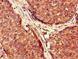 Immunohistochemistry of paraffin-embedded human ovarian cancer using USP6 Antibody at dilution of 1:100Rabbit anti-Human USP6 Polyclonal Antibody