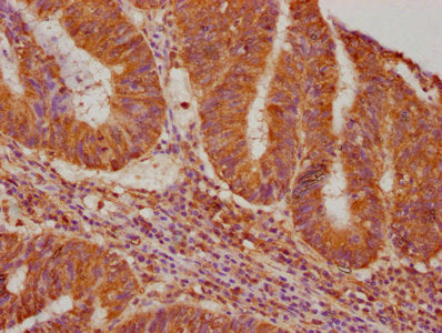 IHC image of VASN Antibody diluted at 1:640 and staining in paraffin-embedded human colon cancer performed on a Leica BondTM system. After dewaxing and hydration, antigen retrieval was mediated by high pressure in a citrate buffer (pH 6.0). Section was blocked with 10% normal goat serum 30min at RT. Then primary antibody (1% BSA) was incubated at 4°C overnight. The primary is detected by a biotinylated secondary antibody and visualized using an HRP conjugated SP system.Rabbit anti-Human VASN Polyclonal Antibody