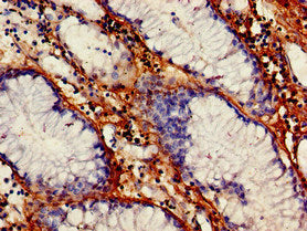Immunohistochemistry of paraffin-embedded human gastric cancer using VEGFB Antibody at dilution of 1:100Rabbit anti-Human VEGFB Polyclonal Antibody