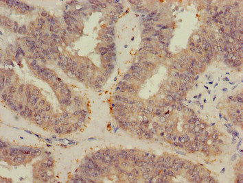Immunohistochemistry of paraffin-embedded human endometrial cancer using VEGFB Antibody at dilution of 1:100Rabbit anti-Human VEGFB Polyclonal Antibody