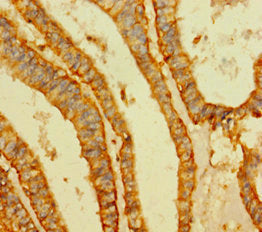 Immunohistochemistry of paraffin-embedded human endometrial cancer using VIM Antibody at dilution of 1:100Rabbit anti-Human VIM Polyclonal Antibody