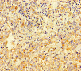 Immunohistochemistry of paraffin-embedded human lung cancer using VIM Antibody at dilution of 1:100Rabbit anti-Human VIM Polyclonal Antibody
