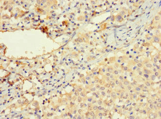 Immunohistochemistry of paraffin-embedded human lung cancer using VTN Antibody at dilution of 1:100Rabbit anti-Human VTN Polyclonal Antibody