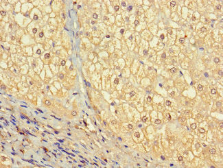 Immunohistochemistry of paraffin-embedded human liver cancer using VTN Antibody at dilution of 1:100Rabbit anti-Human VTN Polyclonal Antibody