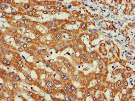 Immunohistochemistry of paraffin-embedded human liver cancer using WISP3 Antibody at dilution of 1:100Rabbit anti-Human WISP3 Polyclonal Antibody