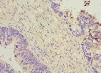 Immunohistochemistry of paraffin-embedded human ovarian cancer using WNT7B Antibody at dilution of 1:100Rabbit anti-Human WNT7B Polyclonal Antibody
