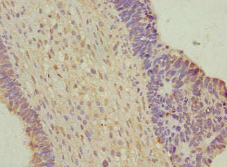 Immunohistochemistry of paraffin-embedded human ovarian cancer using the antibody at dilution of 1:100Rabbit anti-Human WNT7B Polyclonal Antibody