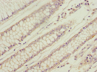 Immunohistochemistry of paraffin-embedded human colon cancer using the antibody at dilution of 1:100Rabbit anti-Human WNT9A Polyclonal Antibody