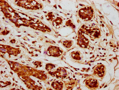 IHC image of WNT9A Antibody diluted at 1:245 and staining in paraffin-embedded human breast cancer performed on a Leica BondTM system. After dewaxing and hydration, antigen retrieval was mediated by high pressure in a citrate buffer (pH 6.0). Section was blocked with 10% normal goat serum 30min at RT. Then primary antibody (1% BSA) was incubated at 4°C overnight. The primary is detected by a biotinylated secondary antibody and visualized using an HRP conjugated SP system.Rabbit anti-Human WNT9A Polyclonal Antibody