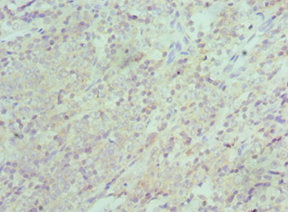Immunohistochemistry of paraffin-embedded human colon cancer using XIAP Antibody at dilution of 1:100Rabbit anti-Human XIAP Polyclonal Antibody