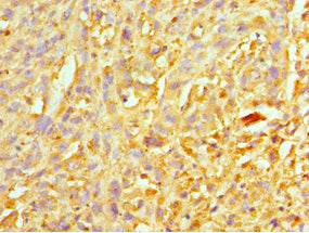 Immunohistochemistry of paraffin-embedded human melanoma using XIAP Antibody at dilution of 1:100Rabbit anti-Human XIAP Polyclonal Antibody