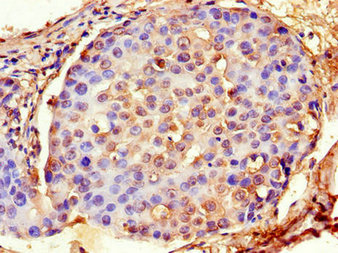 Immunohistochemistry of paraffin-embedded human breast cancer using ACTG1 Antibody at dilution of 1:100