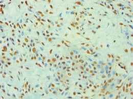 Immunohistochemistry of paraffin-embedded human breast cancer using XRCC5 Antibody at dilution of 1:100Rabbit anti-Human XRCC5 Polyclonal Antibody