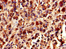 Immunohistochemistry of paraffin-embedded human melanoma using XRCC5 Antibody at dilution of 1:100Rabbit anti-Human XRCC5 Polyclonal Antibody