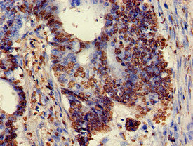 Immunohistochemistry of paraffin-embedded human colon cancer using XRCC5 Antibody at dilution of 1:100Rabbit anti-Human XRCC5 Polyclonal Antibody