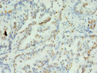 Immunohistochemistry of paraffin-embedded human lung cancer using XRCC5 Antibody at dilution of 1:100Rabbit anti-Human XRCC5 Polyclonal Antibody