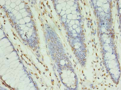 Immunohistochemistry of paraffin-embedded human colon cancer using XRCC5 Antibody at dilution of 1:100Rabbit anti-Human XRCC5 Polyclonal Antibody