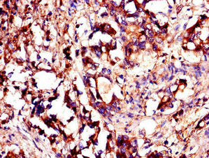 Immunohistochemistry of paraffin-embedded human gastric cancer using YES1 Antibody at dilution of 1:100Rabbit anti-Human YES1 Polyclonal Antibody