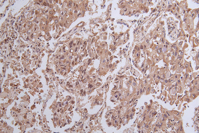 Immunohistochemistry of paraffin-embedded human  lung cancer using the antibody at dilution of 1:100Rabbit anti-Human YWHAG Polyclonal Antibody